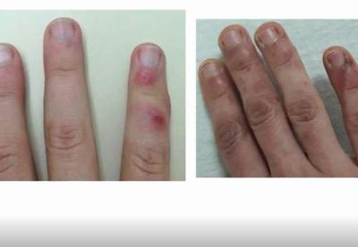 "Dedos de Covid": Médicos brasileiros estudam possível novo sintoma da doença