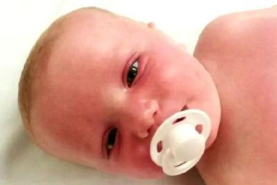 Imagens de bebê que teve reação após uso de protetor solar assustam pais