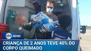 Criança tem 40% do corpo queimado após acidente com panela de pressão | #SBTNews (19/03/25)