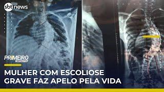 Fila de 7 anos: mulher com escoliose grave faz apelo por cirurgia | Primeiro Impacto (24/04/25)