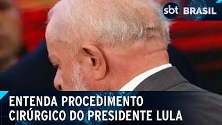 Lula passa por embolização da artéria meníngea; entenda procedimento | SBT Brasil (12/12/24)