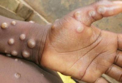 Cientistas cobram mudança do nome "varíola dos macacos"
