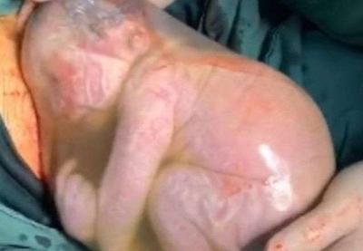 Bebê chinês nasce dentro da bolsa amniótica e imagem ganha o mundo