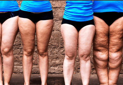 Lipedema: o que fazer quando há acúmulo de gordura nas pernas?  