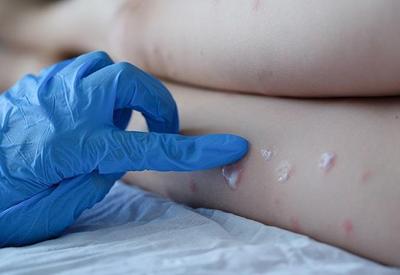 Número de casos de varíola dos macacos chega a 257 em 20 países, diz OMS