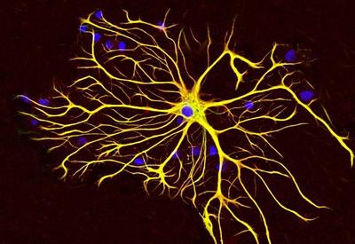 Proteger o cérebro do Alzheimer? Estudo brasileiro traz nova aposta contra a doença; entenda