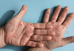Imagem da notícia Mpox: quais são os sintomas e os principais grupos de risco para doença?