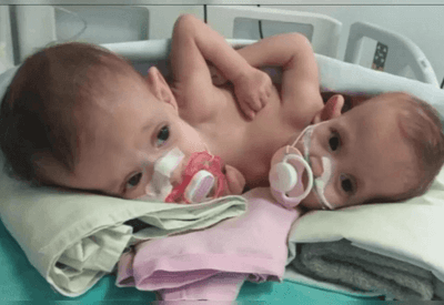 Gêmeas siamesas com três pernas recebem alta hospitalar em Goiânia após 10 meses de internação