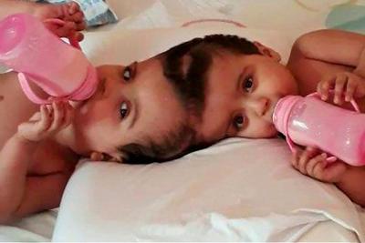 Gêmeas siamesas são separadas em cirurgia inédita no Brasil