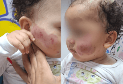 Bebê deixa creche com diversos hematomas no rosto em SP