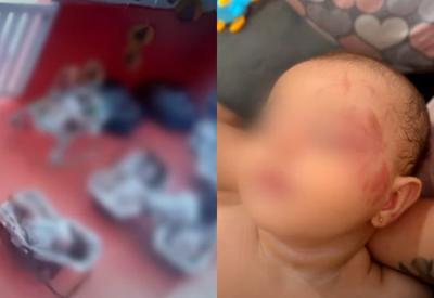 Bebê de cinco meses volta de creche com marcas de mordida no rosto no interior de SP