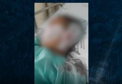 Menino de 9 anos baleado no rosto por amigo não vai passar por cirurgia