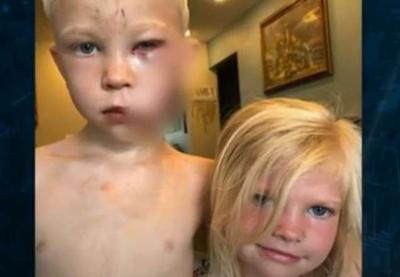 Menino salva irmã caçula de ataque de cachorro e tem rosto desfigurado
