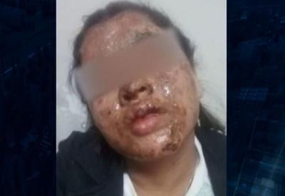 Mulher tem rosto desfigurado por ácido em assalto no ES