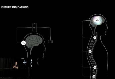 Neuralink: 1º chip cerebral foi instalado em paciente, diz Elon Musk