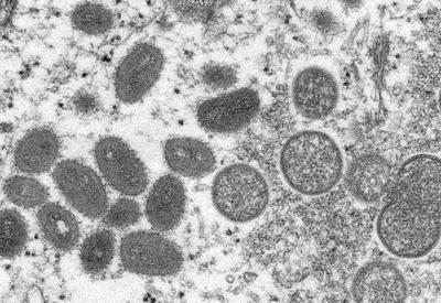 Caso raro de varíola de macaco é confirmado na Inglaterra