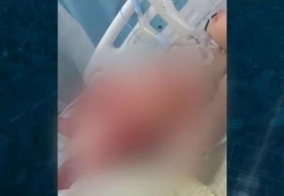 RJ: bebê de 6 meses sofre graves queimaduras após banho em hospital