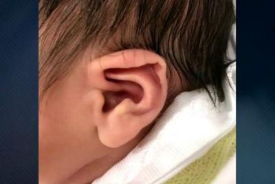 Tratamento sem cirurgia para orelhas de abano é esperança de muitos pais
