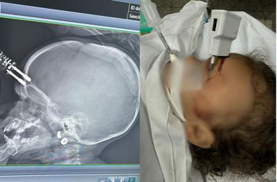 Bebê de 1 ano cai da cama e fica com carregador cravado na testa em MG