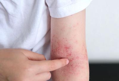 SUS inclui 3 novos medicamentos no tratamento de dermatite atópica