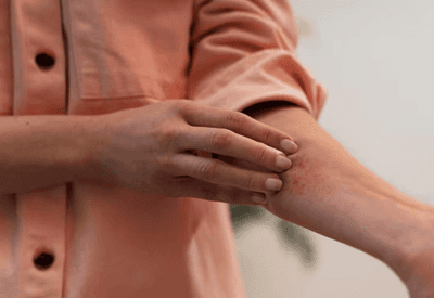 Dermatite atópica piora no frio e com tempo seco: saiba como cuidar da pele