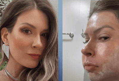 Dono de clínica compara rosto deformado de mulher com peixe após procedimento com PMMA