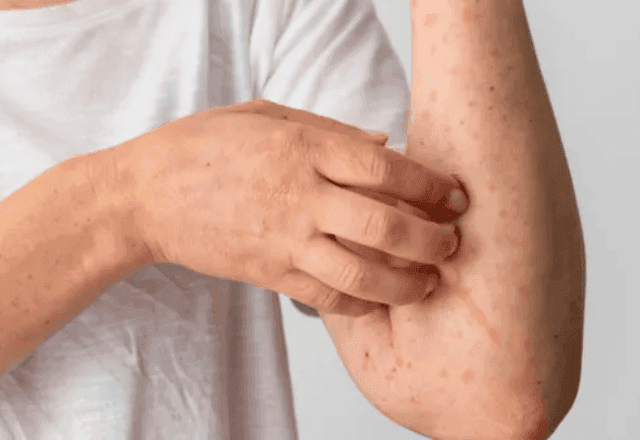 Bahia confirma dois casos de Mpox em 2026