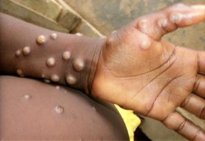 Surto de varíola dos macacos pode ter origem em raves na Europa