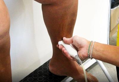 Varizes: quando a saúde das pernas exige atenção médica