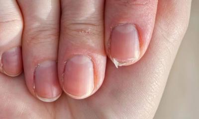 Unhas fracas e quebradiças? Conheça as causas e soluções recomendadas 