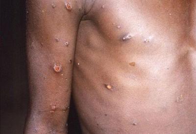 Brasil se aproxima de 600 casos confirmados de varíola dos macacos