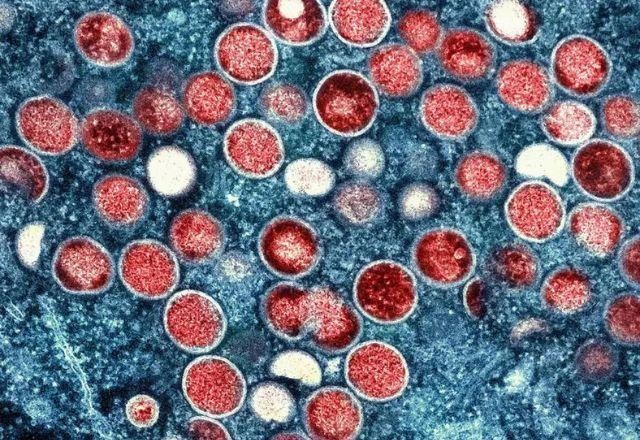 Imagem da noticia Brasil chega a 836 casos prováveis de Mpox em 2024