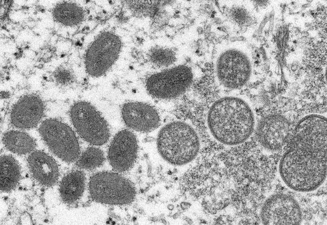 Imagem da noticia Agência europeia aponta para 219 casos confirmados de varíola dos macacos