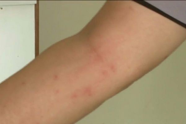 Cidade gaúcha registra mais de 200 casos de alergia à mariposa 