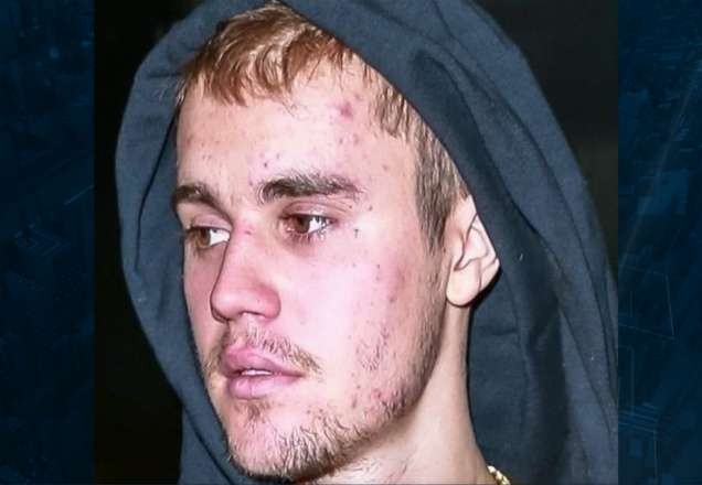 Imagem da noticia Doença de Lyme: saiba mais sobre doença que afeta Justin Bieber