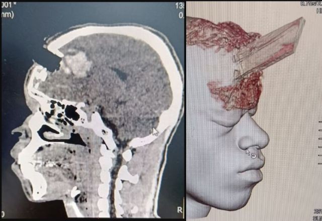 Estaca de madeira perfura cabeça de homem; cirurgia de retirada é considerada um sucesso