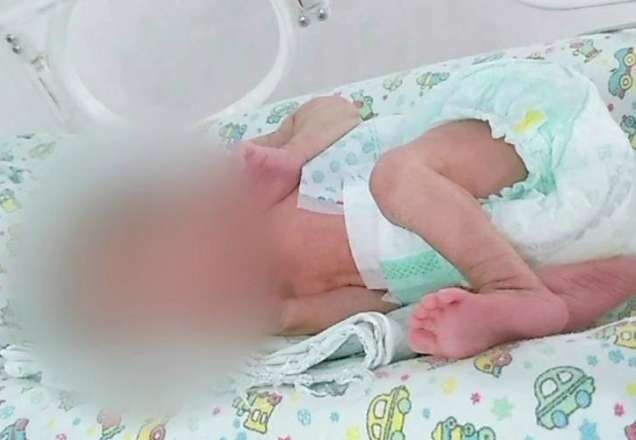 Família acusa maternidade por queimaduras em recém-nascida