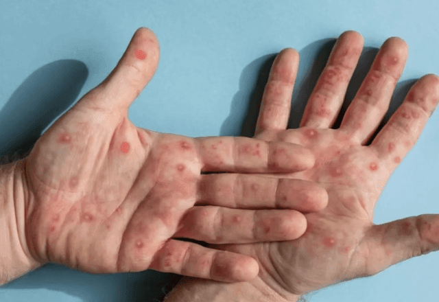 Imagem da noticia Mpox: quais são os primeiros sintomas e como identificar a doença?