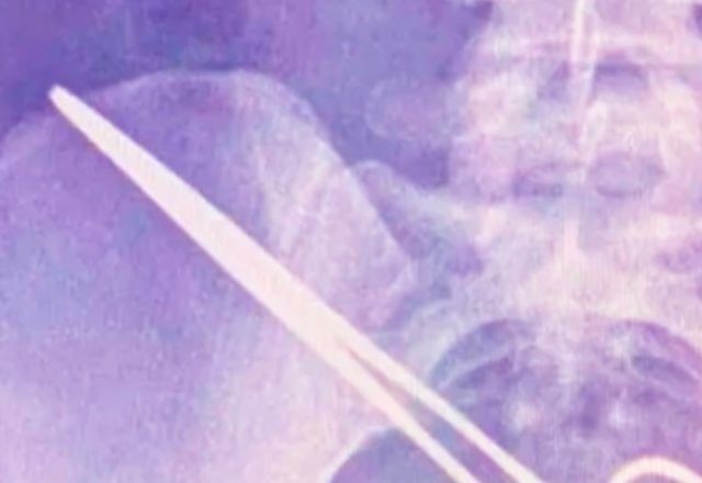 Imagem da noticia Justiça de MG condena médico que esqueceu pinça na coluna de paciente após cirurgia