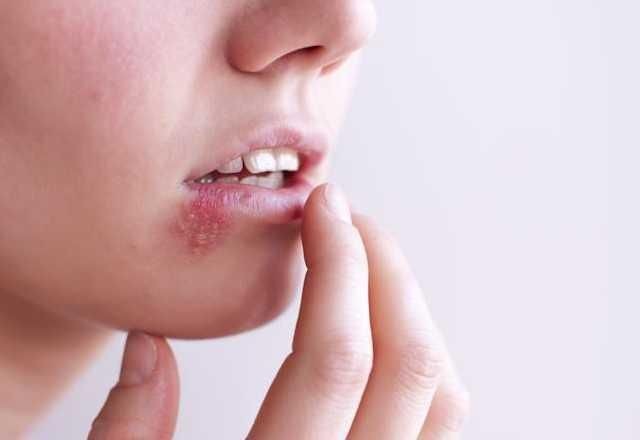 Imagem da noticia Estresse e excesso de sol podem "despertar" herpes; entenda