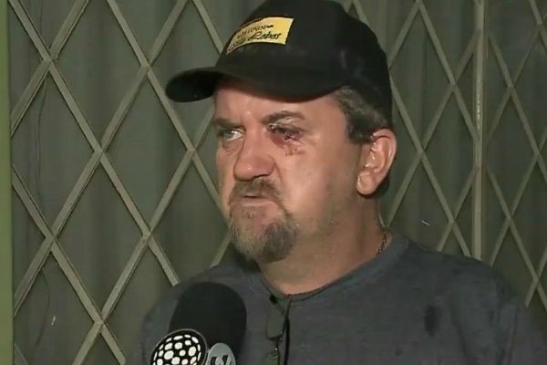 Imagem da noticia Homem atingido por fogos de artifício corre risco de perder a visão