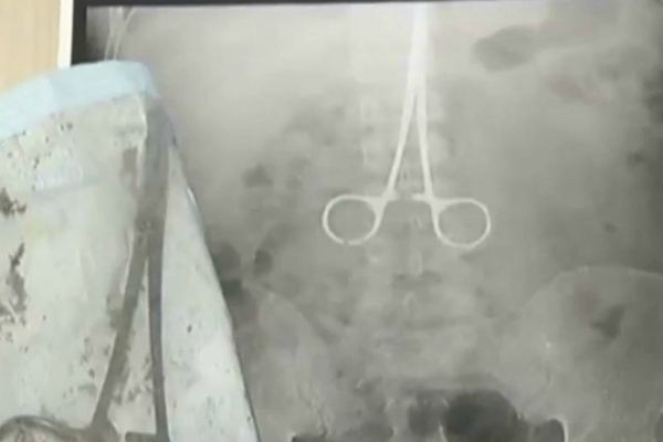 Imagem da noticia Homem vive 15 anos com pinça na barriga; objeto foi esquecido em cirurgia