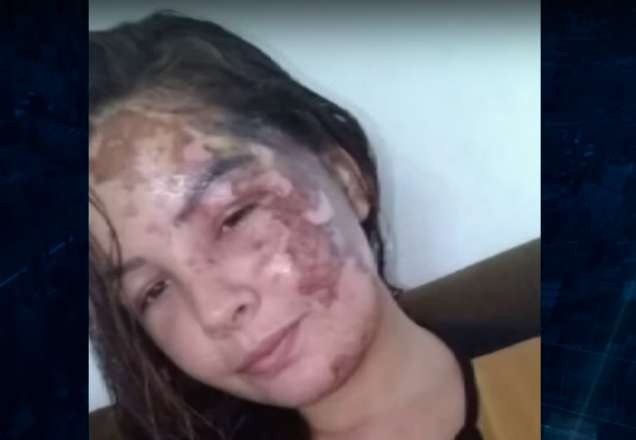 Jovem de 20 anos tem rosto queimado com óleo quente por ex-namorado