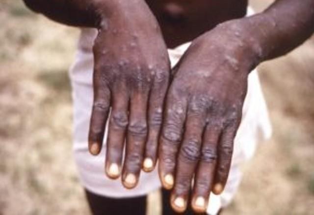 Imagem da noticia Ministério da Saúde confirma cinco novos casos de varíola do macaco