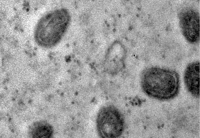 Imagem da noticia Paquistão registra primeiro caso de mpox; Ministério da Saúde aguarda exame para detectar cepa