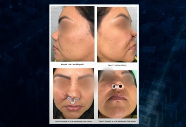 Imagem da noticia GO: mulher perde parte do nariz após procedimento estético