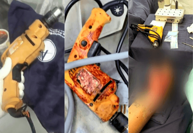 Imagem da noticia Hospital de São Paulo usa furadeira doméstica em cirurgias ortopédicas