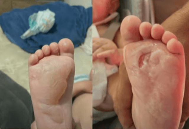 Imagem da noticia Bebê queima os dois pés em creche no interior de São Paulo