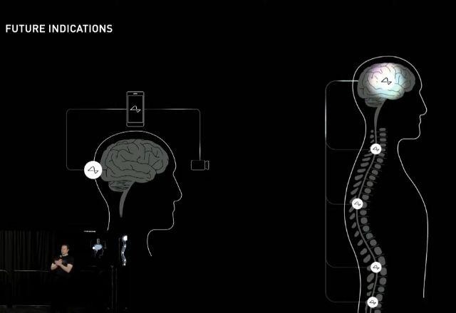 Imagem da noticia Neuralink: 1º chip cerebral foi instalado em paciente, diz Elon Musk