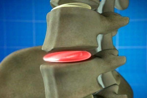 Imagem da noticia Nova cirurgia promete recuperação mais rápida para quem tem hérnia de disco